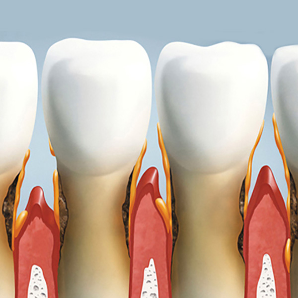 Cura della Parodontite